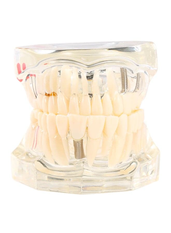 Dental Implantation Disease Teeth Model Multicolour