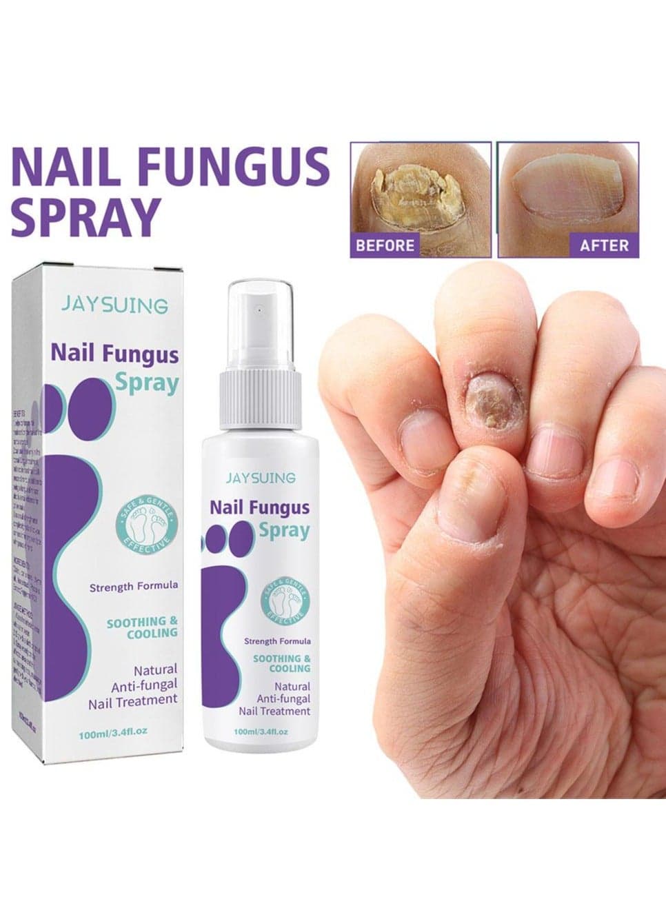 100ml Nail Fungus Treatment Beauty Health Remedy Serum Essence Anti Paronychia Onychomycosis Fungus Removal Gel Foot Care